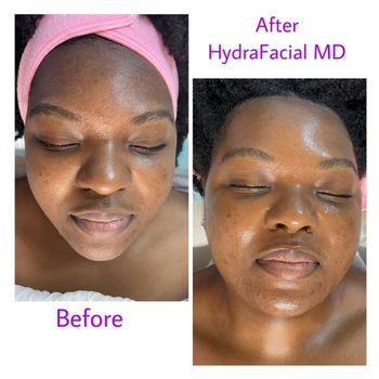 Personalized HydraFacial Treatment Before and After