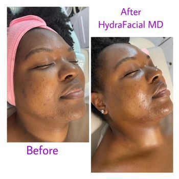 Personalized HydraFacial Treatment Before and After