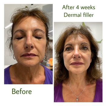 Before and After Dermal Filler Treatment in Florida