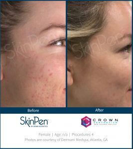 Before and After SkinPen Microneedling Treatment
