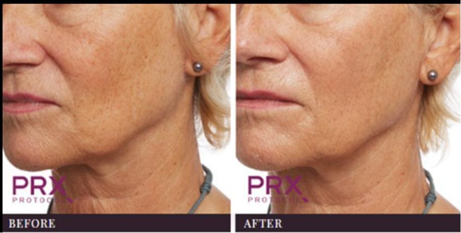 PRX-T33 Peel Treatment Before and After - Immediate Results in Florida