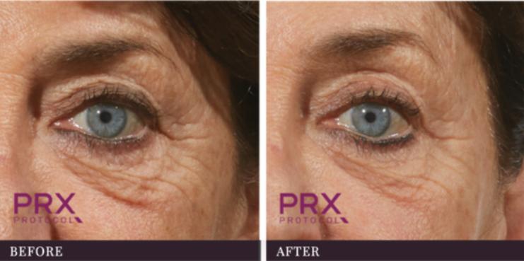 PRX-T33 Peel Treatment Before and After - Immediate Results in Florida