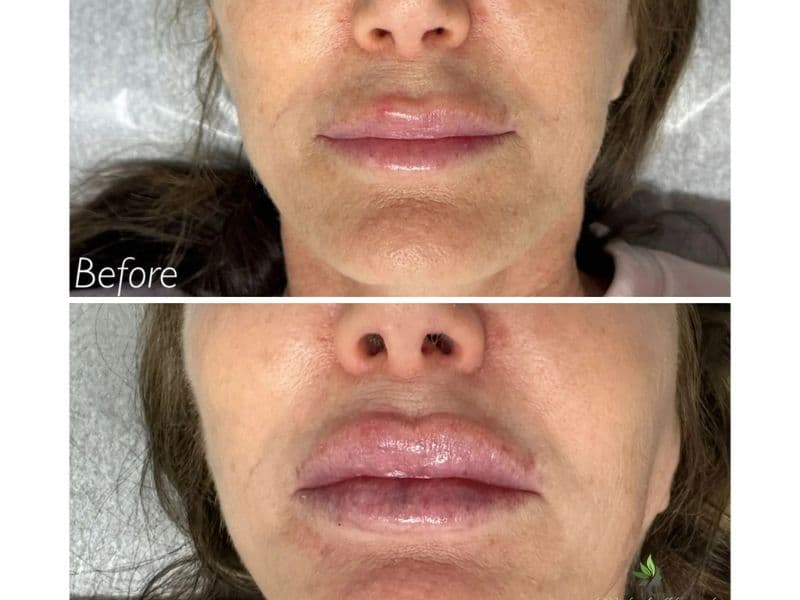 before and after laser hair removal