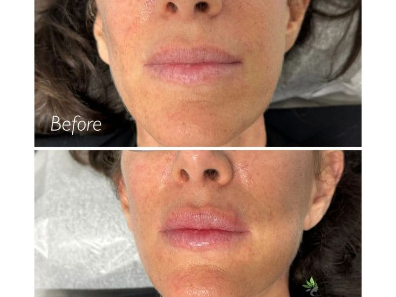 before and after laser hair removal