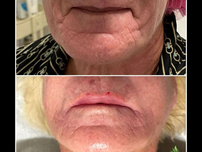 before and after laser hair removal