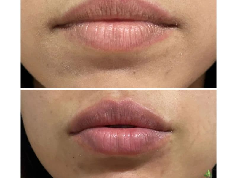 before and after laser hair removal