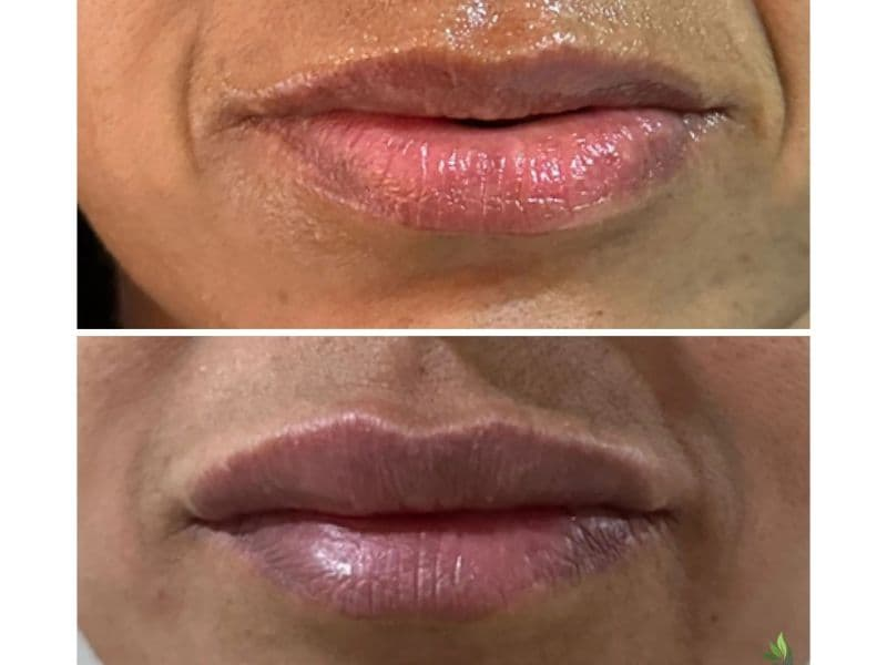 before and after laser hair removal