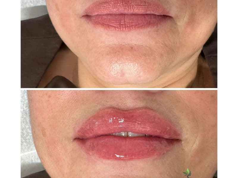 before and after laser hair removal