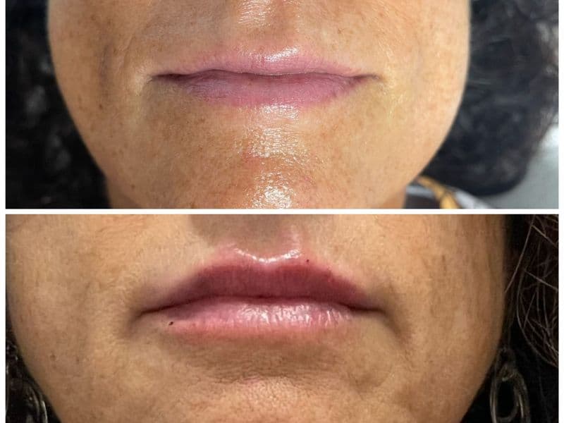 before and after laser hair removal