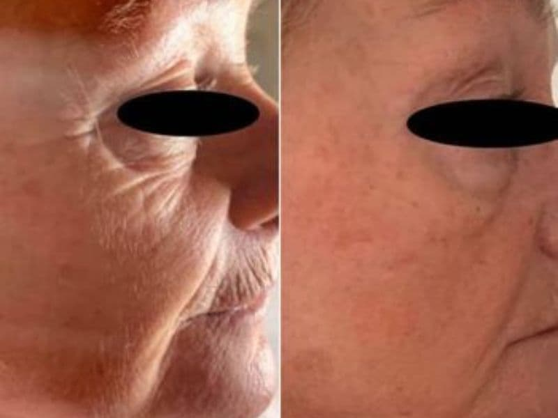 before and after laser hair removal