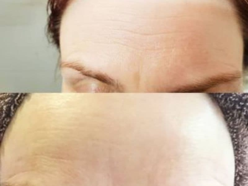 before and after laser hair removal