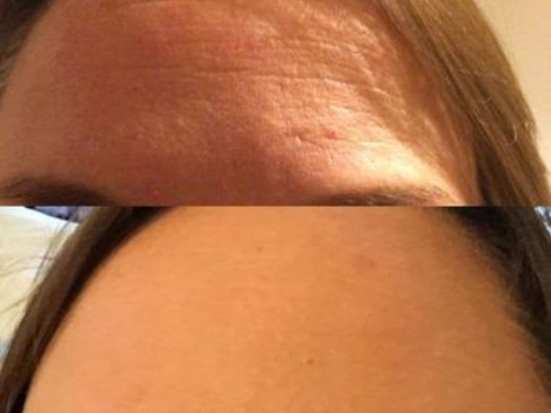 before and after laser hair removal