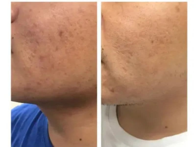 before and after laser hair removal