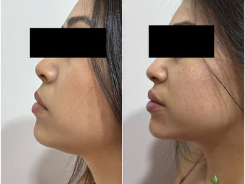 before and after laser hair removal