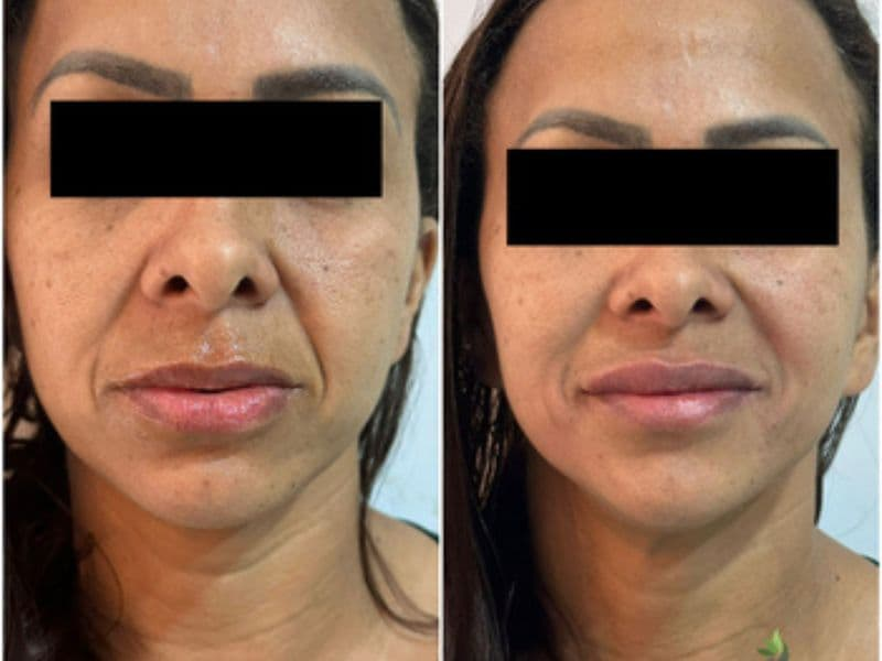 before and after laser hair removal