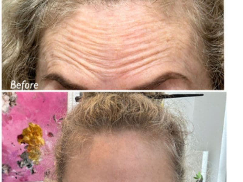 before and after laser hair removal