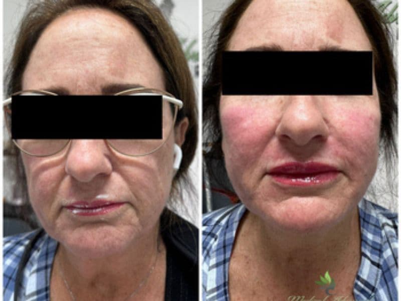 before and after laser hair removal