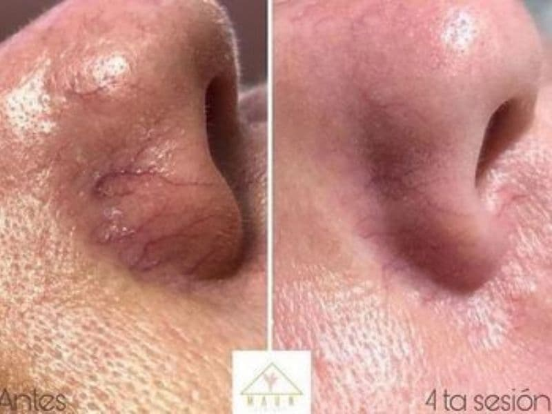 before and after laser hair removal