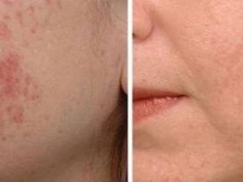 before and after laser hair removal