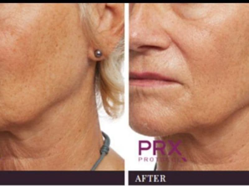 before and after laser hair removal