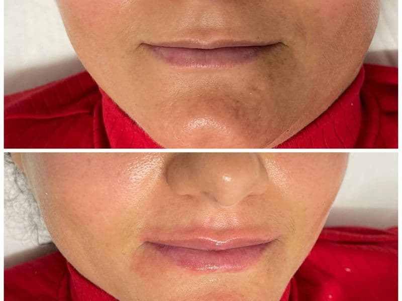 before and after laser hair removal