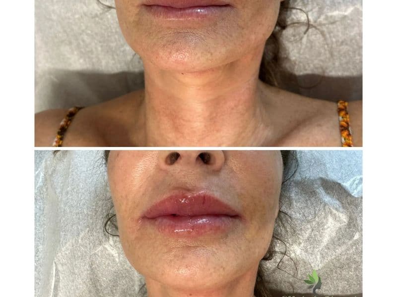 before and after laser hair removal