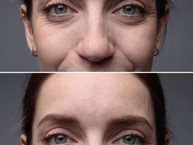 before and after laser hair removal