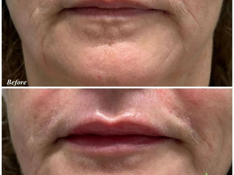 before and after laser hair removal