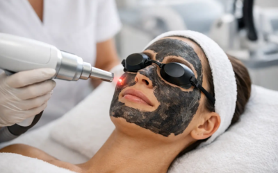 Carbon Peel Laser Facial: What to Expect