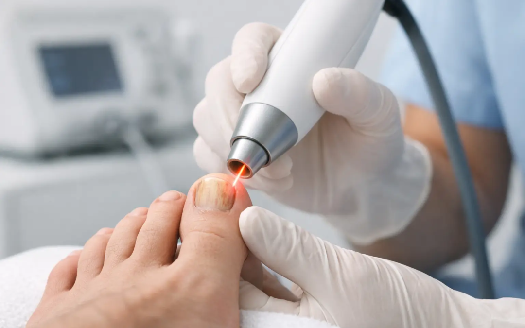 Toenail Fungus Laser Treatment Explained