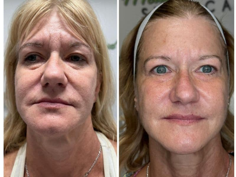 before and after laser hair removal