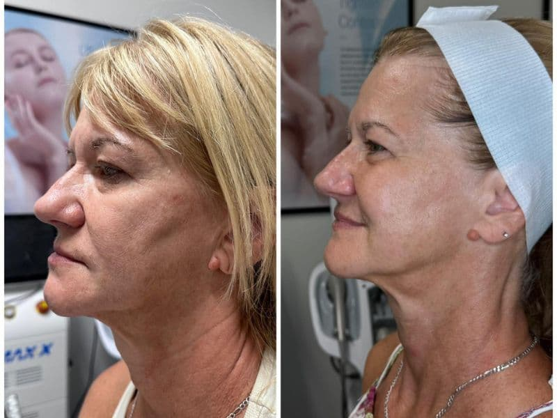 before and after laser hair removal