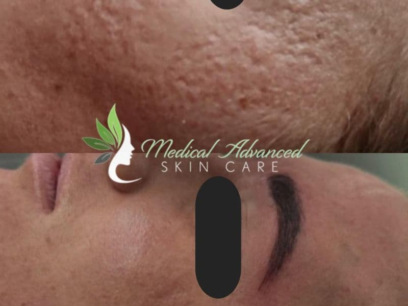 before and after laser hair removal