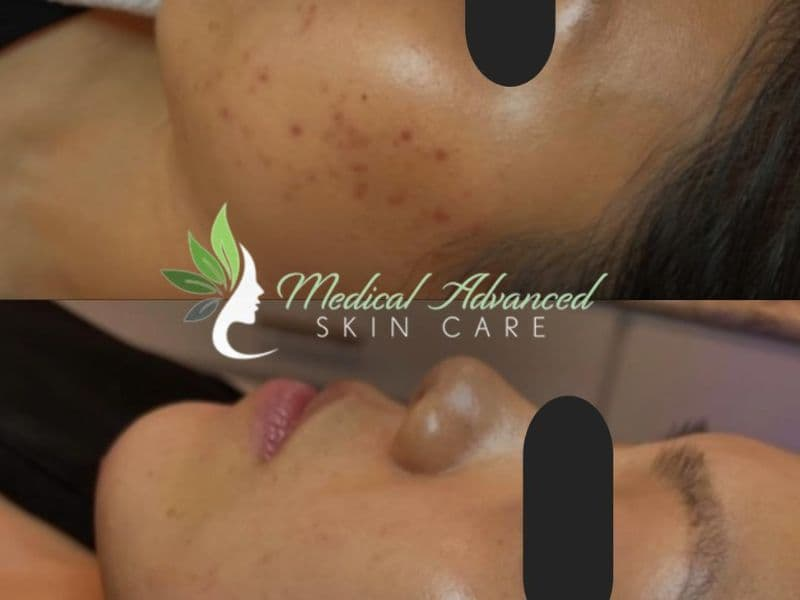 before and after laser hair removal