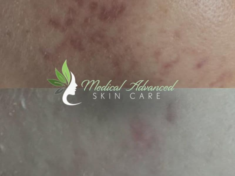 before and after laser hair removal