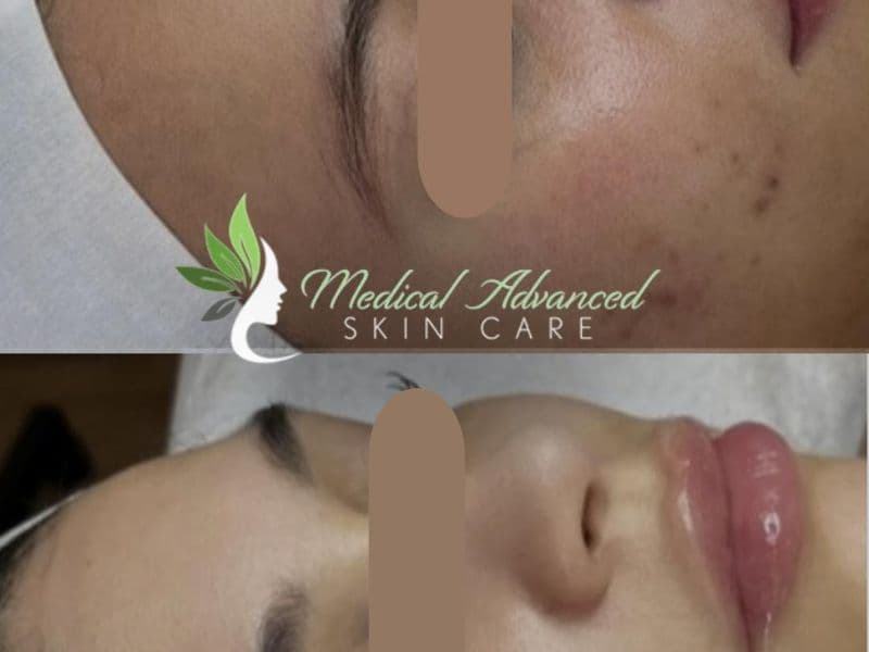 before and after laser hair removal