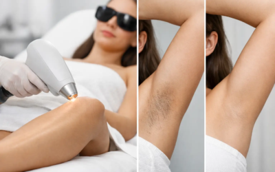 Laser Hair Removal Before After Examples Explained