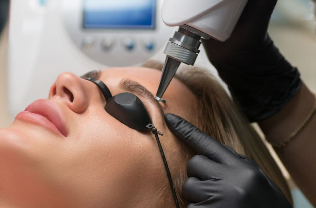 laser hair removal eyebrows