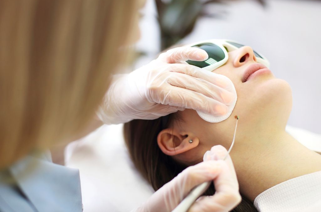aser hair removal neck